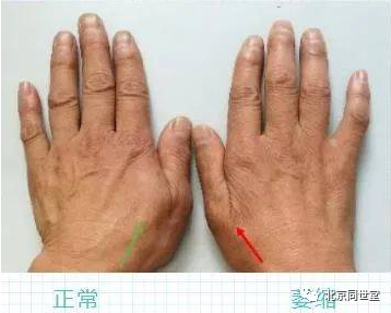 渐冻人早期症状(渐冻人早期症状如何)