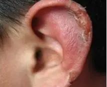 让你从今年冬天开始,彻底告别"冻疮"