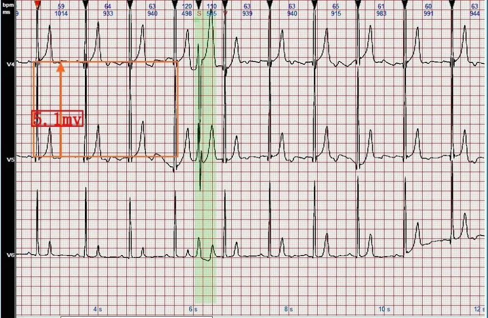心电图病例分析41插入性室性早搏