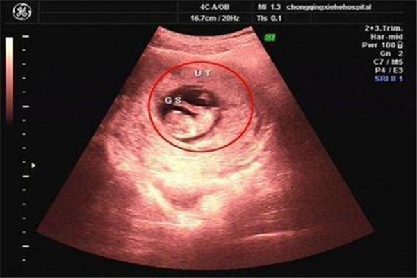 已生女孩孕囊图片早期图片