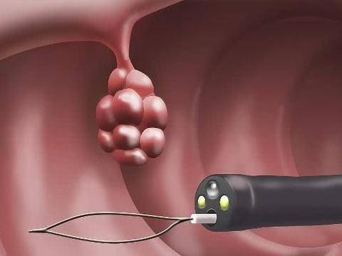 腸道長了息肉出現這4個信號時可能是惡化癌變注意及時去檢查