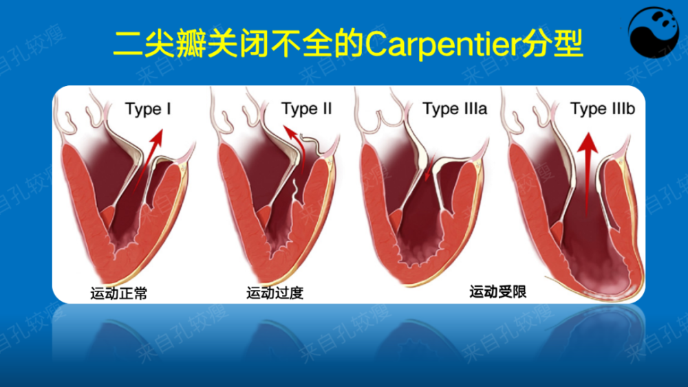手把手教你二尖瓣反流的超声诊断
