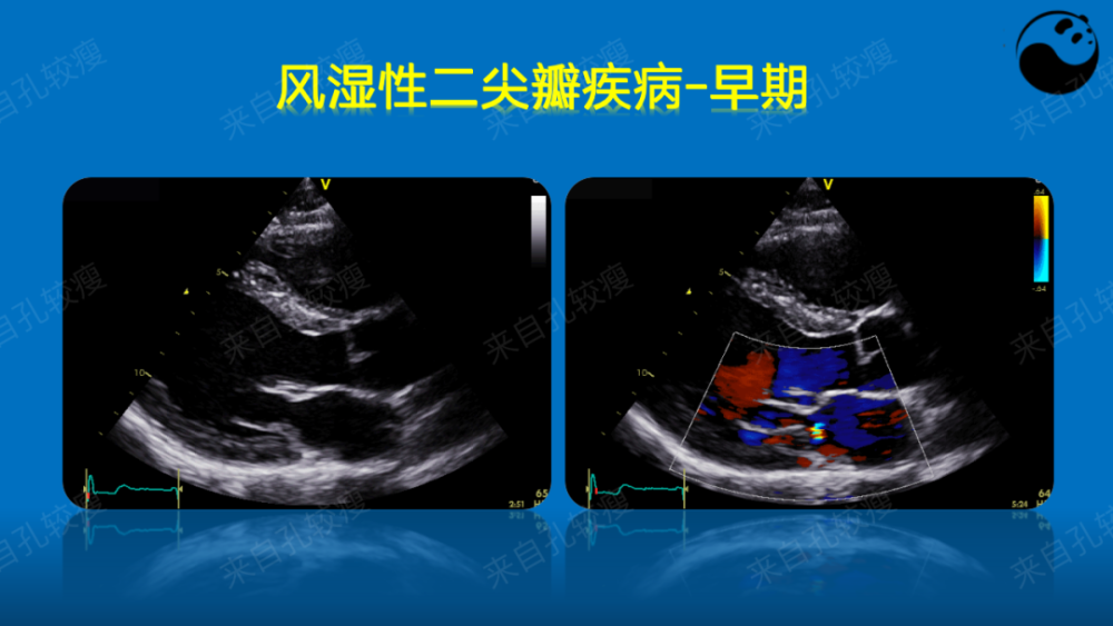 手把手教你二尖瓣反流的超声诊断