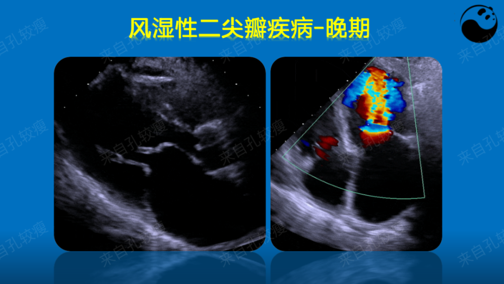 手把手教你二尖瓣反流的超声诊断