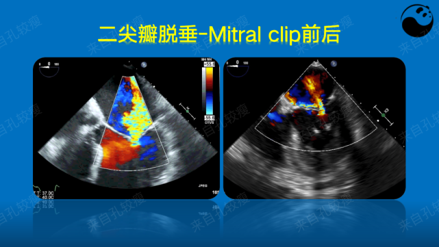 手把手教你二尖瓣反流的超声诊断