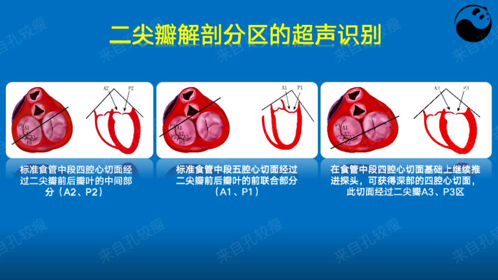手把手教你二尖瓣反流的超声诊断