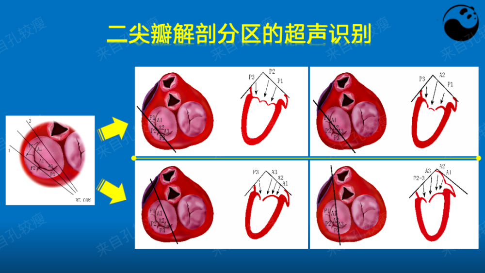 手把手教你二尖瓣反流的超声诊断