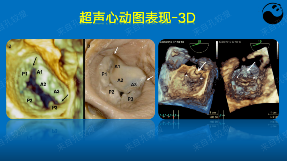 手把手教你二尖瓣反流的超声诊断