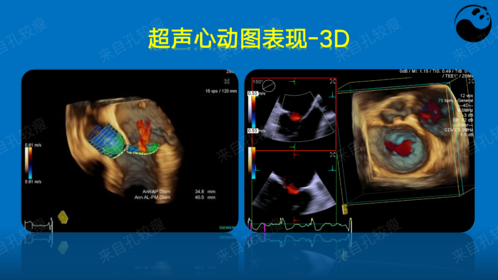 手把手教你二尖瓣反流的超声诊断