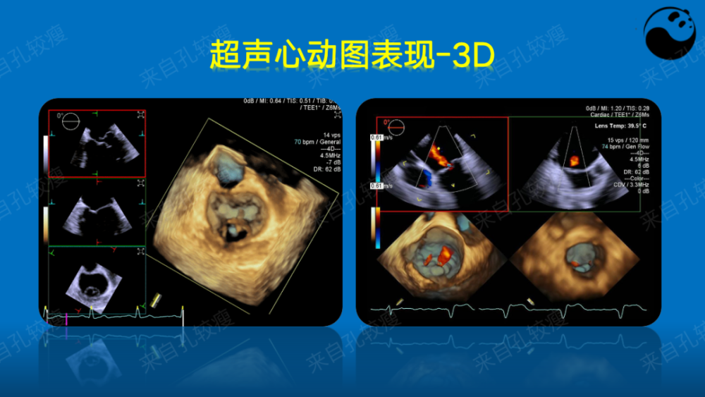 手把手教你二尖瓣反流的超声诊断