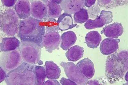 脑脊液检查中发现的病毒包涵体华山细胞形态专栏1