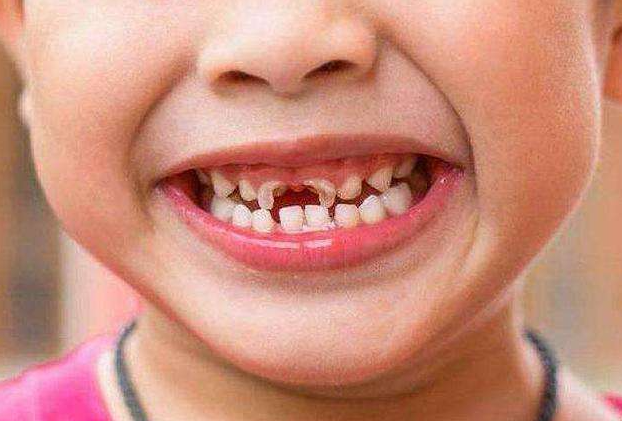 5岁孩子满口小黑牙天天刷牙没效果勿忽略1早3对