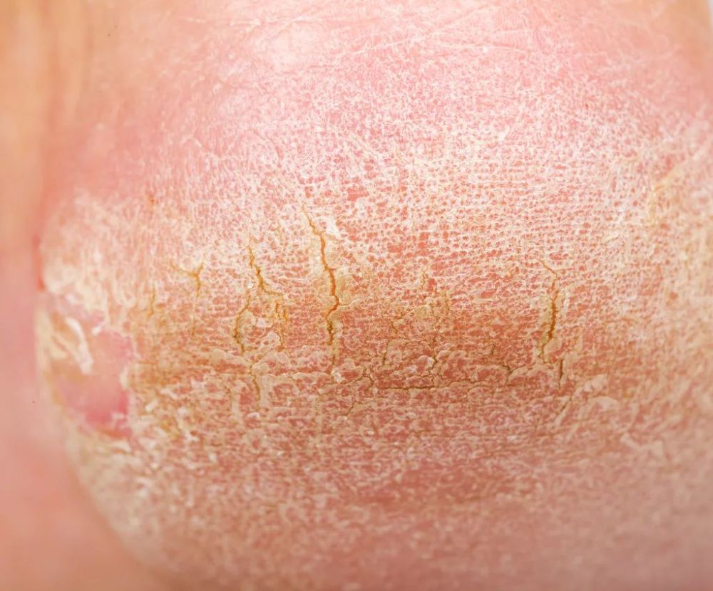 脚后跟干裂小腿长鱼鳞真相不是皮肤缺水而是因为