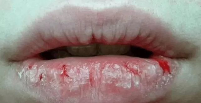 一,什么是"唇风"?