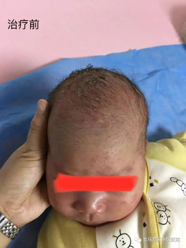 龙马潭区中医医院儿科接诊了一名刚出生1个月的婴儿,宝宝头面部长满