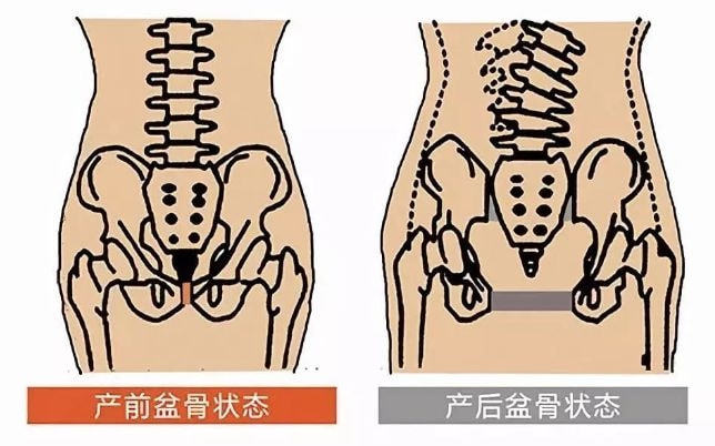 產後為什麼要做骨盆修復答案在這裡