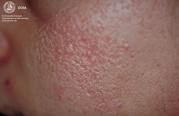 萎缩性毛周角化病,可见虫蚀样外观