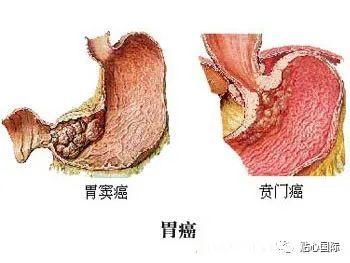 胃体胃窦图片