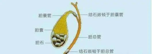 查出胆结石后为什么一定要切除胆囊