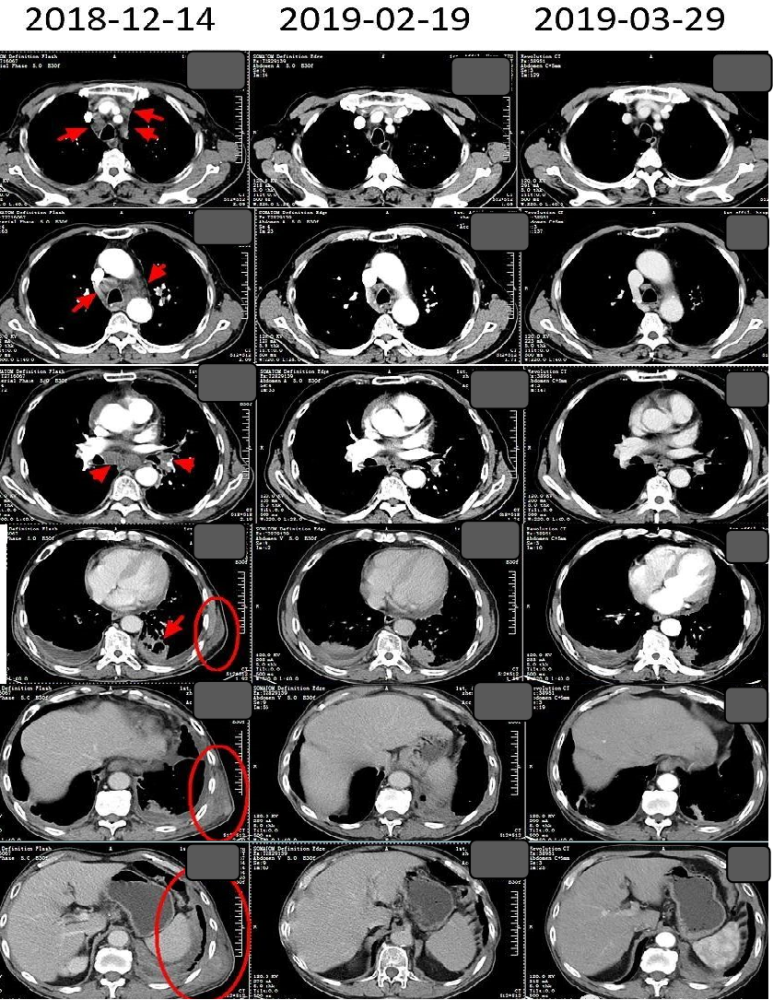 一线化疗失败的met14号外显子跳跃突变晚期肺腺癌赛沃替尼带来肿瘤