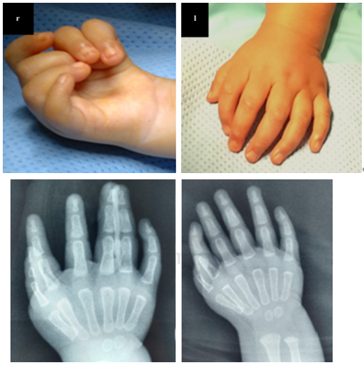 镜影手赘生手分裂手棒状手海豹手你还见过哪几种上肢畸形
