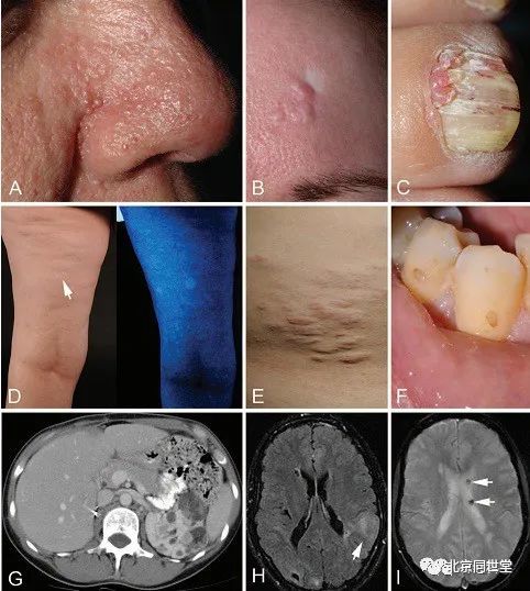 结节性硬化症特征及危害