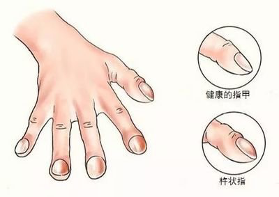 手指出现这些症状是心脏在向你发出求救