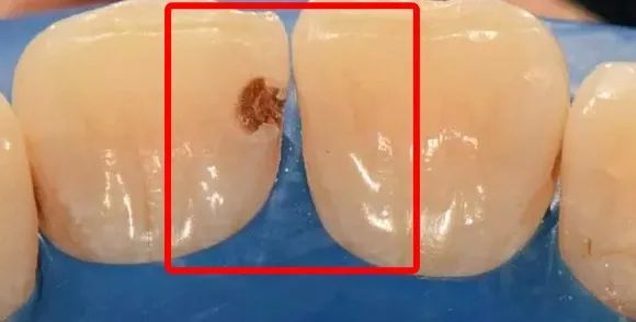这种龋齿隐蔽性极高,破坏性极大,一坏坏两颗!家长一定要注意