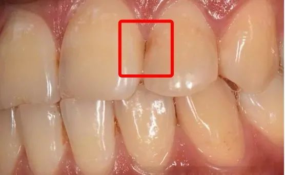 这种龋齿隐蔽性极高,破坏性极大,一坏坏两颗!家长一定要注意