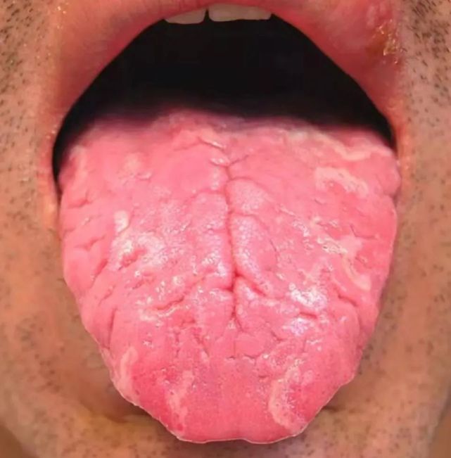 舌头上有深裂纹,竟然是一种病?