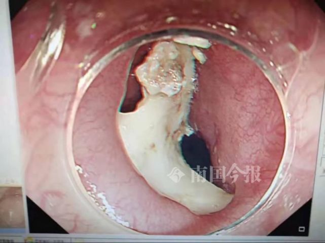 5岁孩子喝粥卡喉柳州医生从其食道中取出一块长约3cm猪骨头