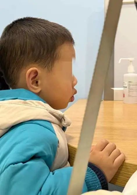 上颌骨变长,硬腭高拱,上切牙突出,牙列不齐导致咬合不良,下颌下垂,唇