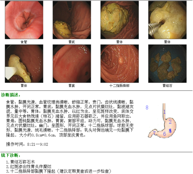 胃結石碎石術;2.紅斑滲出性胃炎伴糜爛.3.十二指腸降部黏膜下隆起.