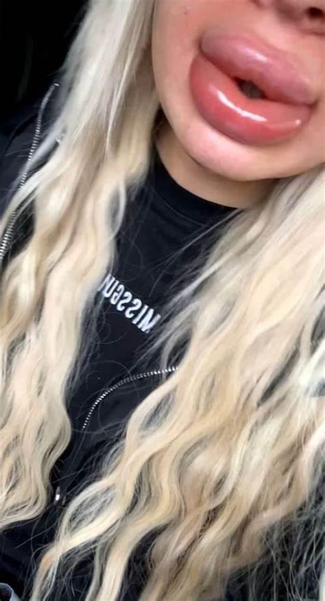 英国24岁女子第一次丰唇肿成香肠嘴填充物膨胀到原来的20倍