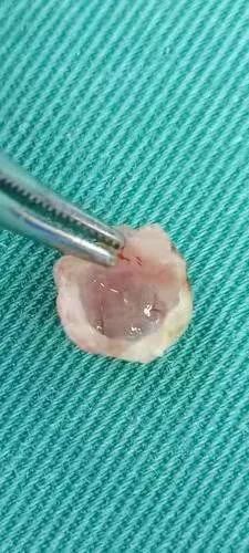 宁夏一新生儿吃奶就呛原是舌根处一囊肿闹妖