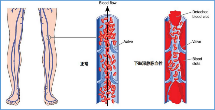 护理科普带您了解抗血栓梯度压力袜