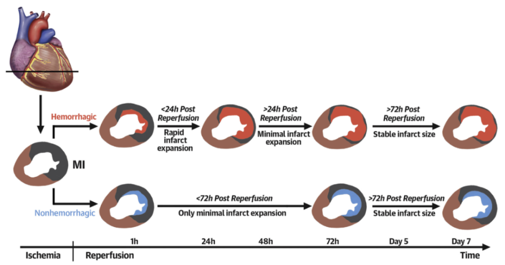 進展|心肌內出血的二次打擊,或為缺血再灌注損傷的幕後真兇_騰訊新聞