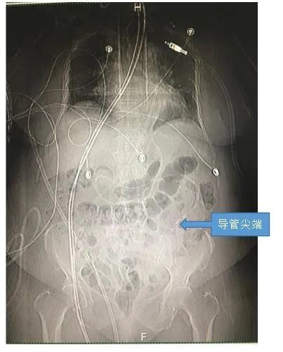 鼻肠管置入成功图片图片