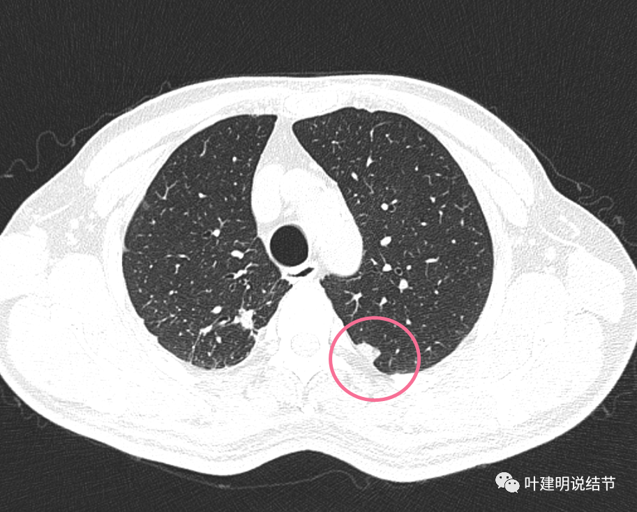 2021年換一個醫院檢出左肺下葉8*6磨玻璃影,上葉結節性改變,三個月後