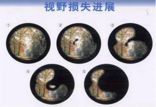 兰州爱尔科普：青光眼是眼泛青光吗?(图1)