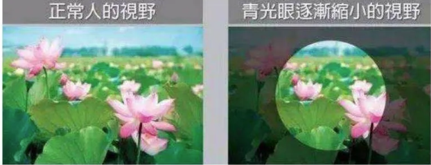 兰州爱尔科普：青光眼是眼泛青光吗?(图2)