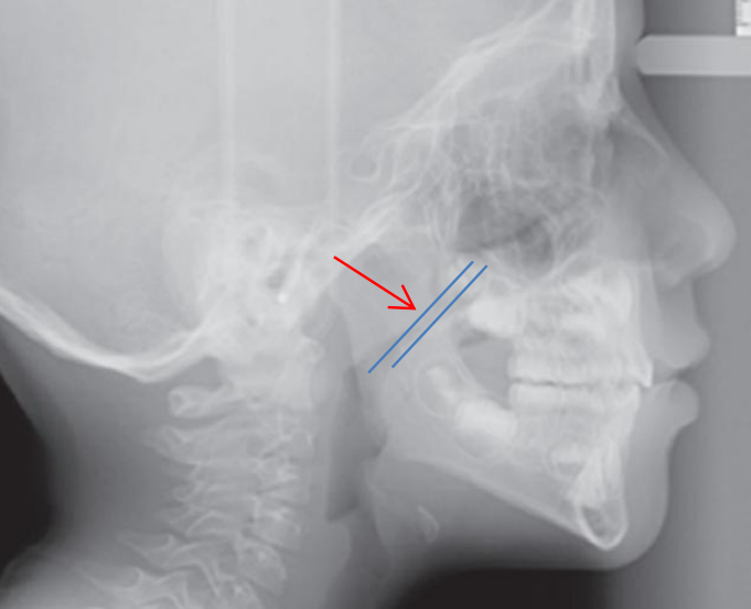 娃睡觉张嘴越长越丑很多小孩都有的腺样体肥大一文说清