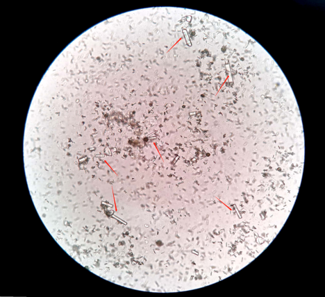 尿沉渣镜检之真假红细胞