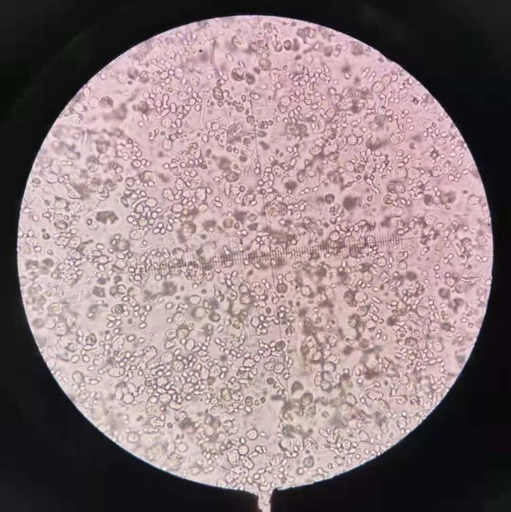 尿沉渣镜检之真假红细胞_腾讯新闻