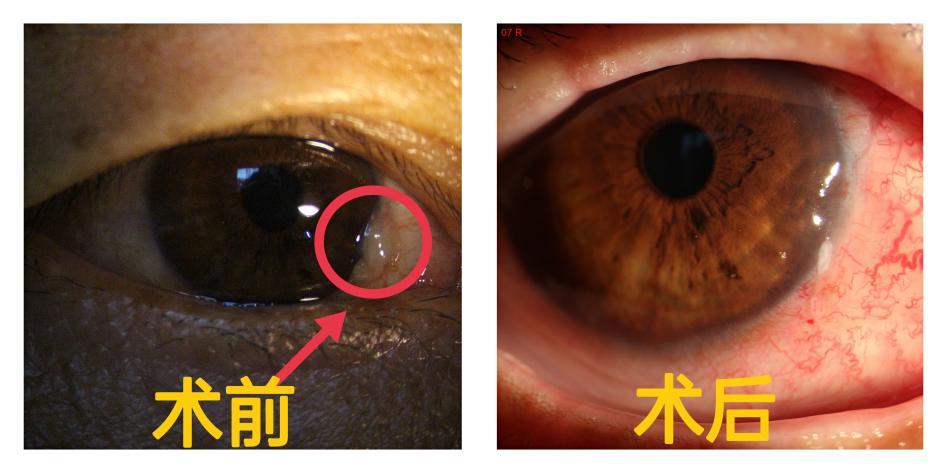 警惕眼內膜狀物生長眼科專家胬肉除帶來不適還很傷眼