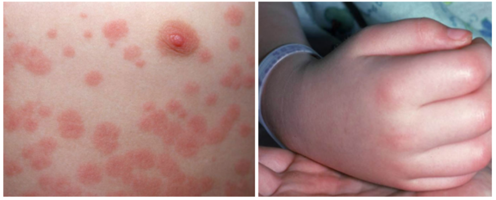 超强图解,教你识别 11 种疹子_腾讯新闻