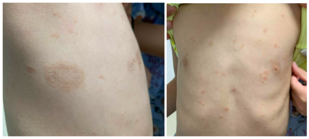 图片来源:专家提供家长如何做玫瑰糠疹是一种急性,自限性皮肤病,即