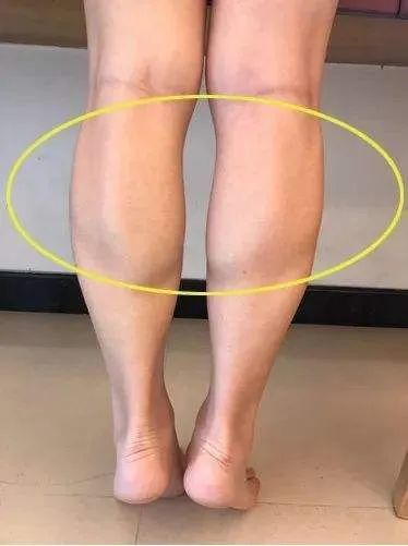 为何女生的腿会比男生粗