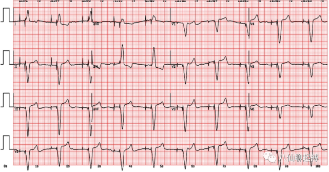 心动过缓心电图特点图片