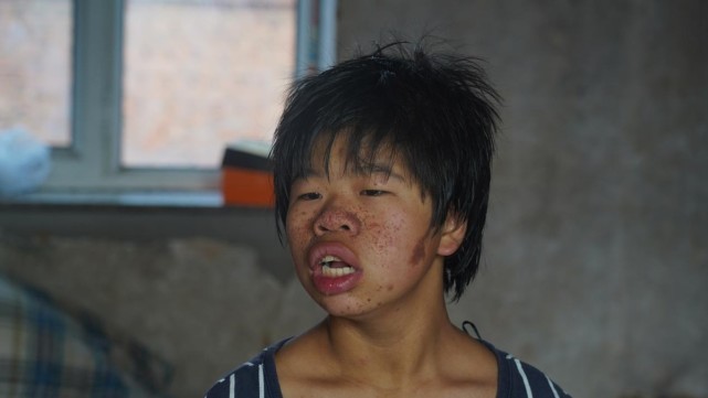 花季少女身患罕见怪病样貌奇异不敢出门甚至被人叫作怪物